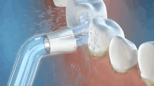 Nettoyeur Dentaire Pro - Votre Sourire Plus Sain au Quotidien